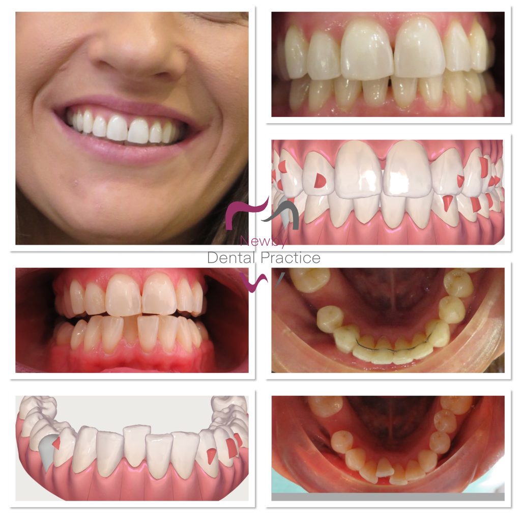 Algin, Bleach and Bond Dentist Scarborough