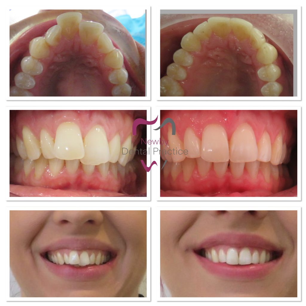 Clear Braces Straight Teeth Invisalign Scarborough UK Dentist