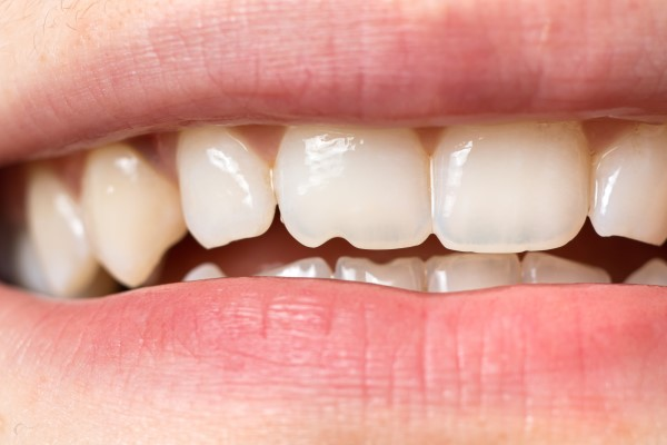 Composite Bonding Scarborough