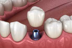 Custom made crown fits precisely onto the dental implant