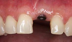 Example of a healing cap on a dental implant