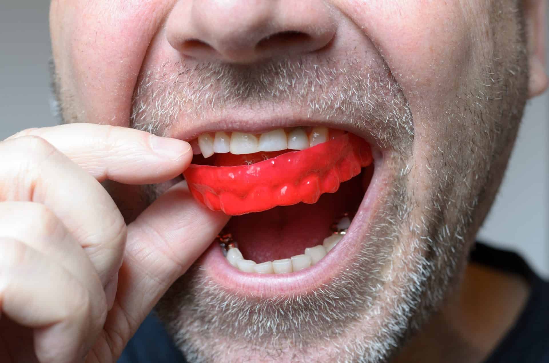 Dental sports mouth guard treatment planned by our dentists in scarborough and york