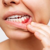 Gum Disease image