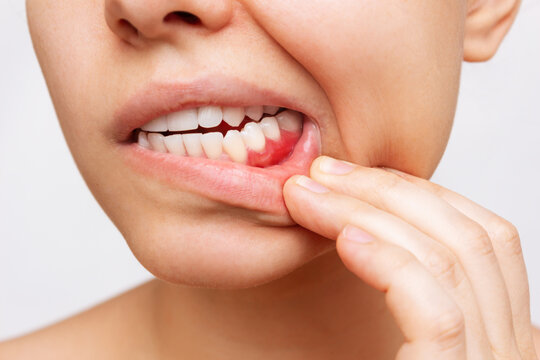 Gum Disease image