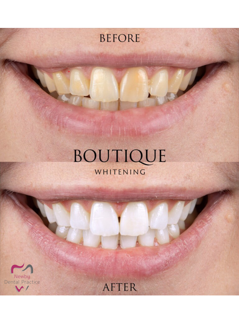 Teeth Whitening Results - before and after (WM)