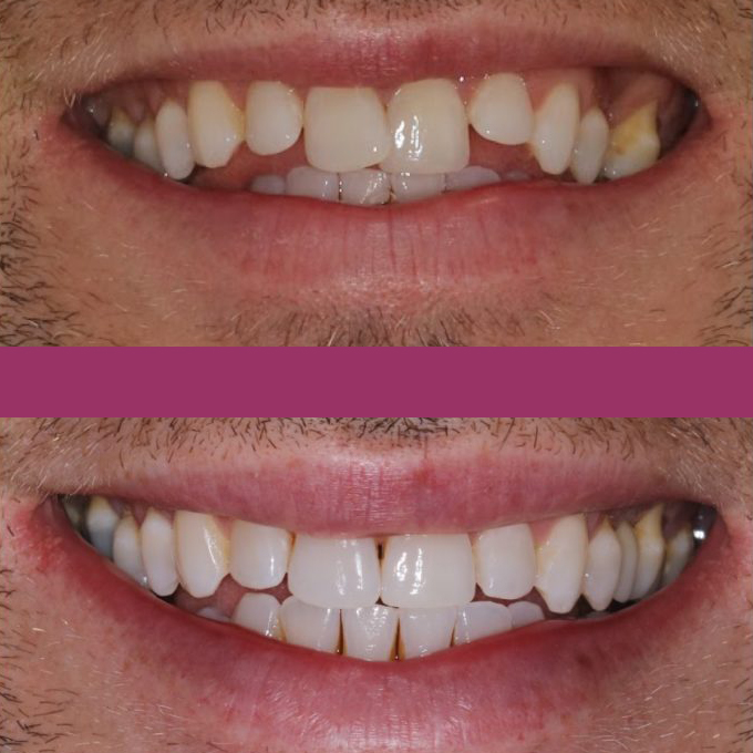 Dental implant before and after Scarborough UK