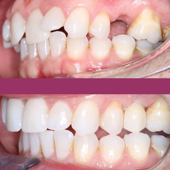 Dental implant before and after Scarborough UK
