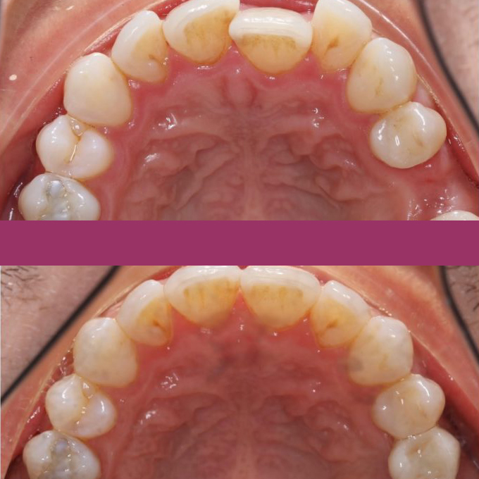 Dental implant before and after Scarborough UK