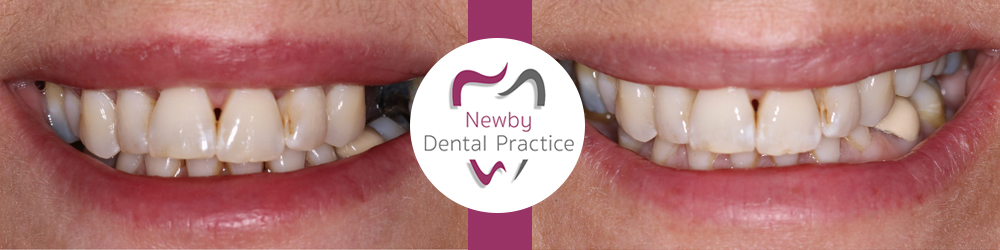 Dental Implant Scarborough UK