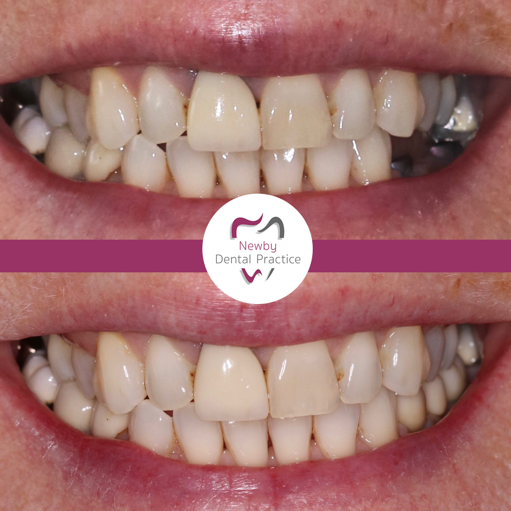 Dental Implants Scarborough