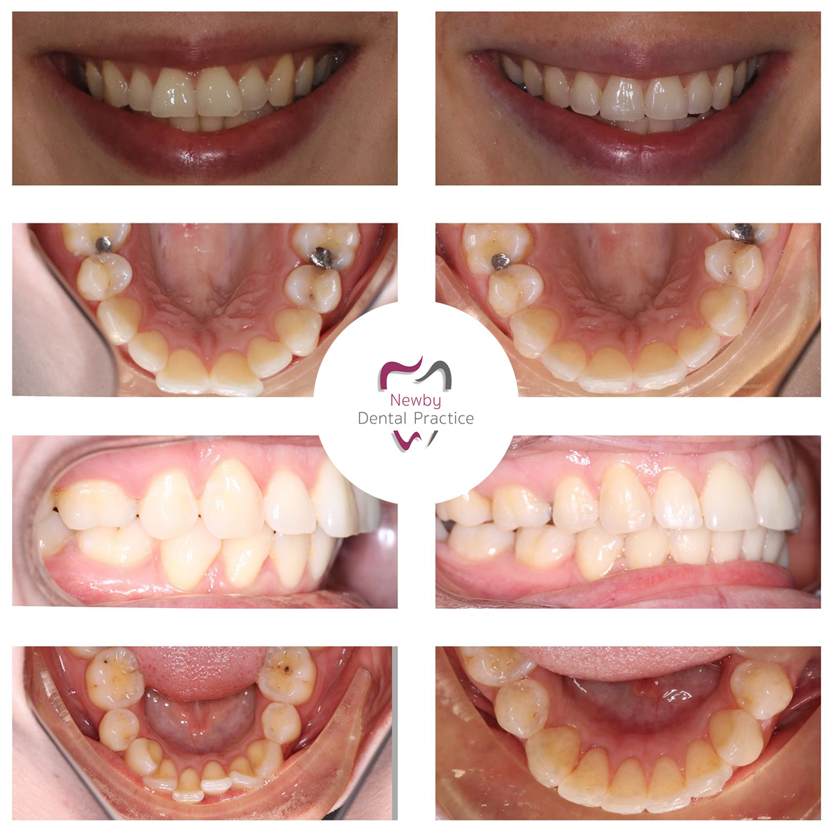 Dentist Invisalign case