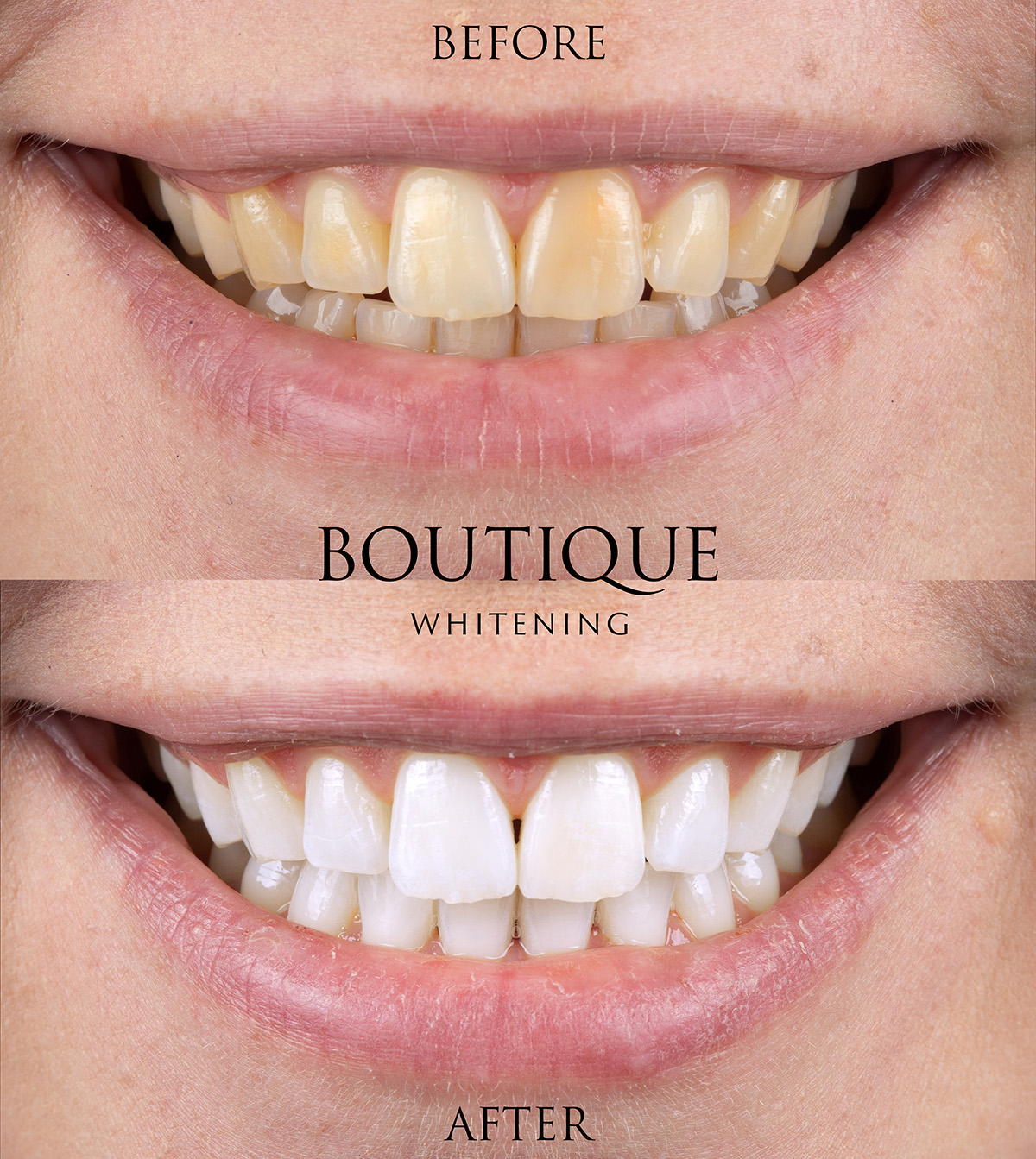 Boutique Tooth Whitening Scarborough UK
