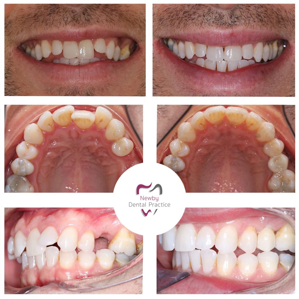 Dental Implant with Invisalign Scarborough UK