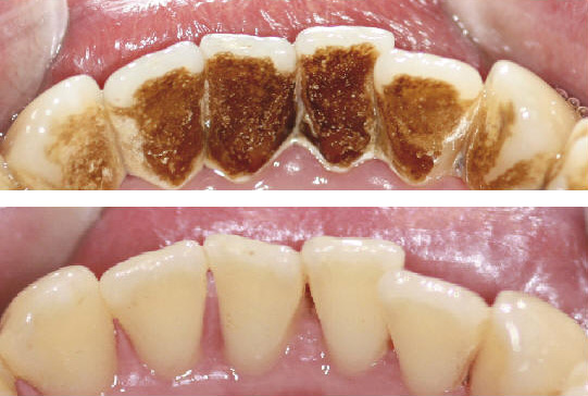 Smokers Dental Cleaning Scarborough North Yorkshire