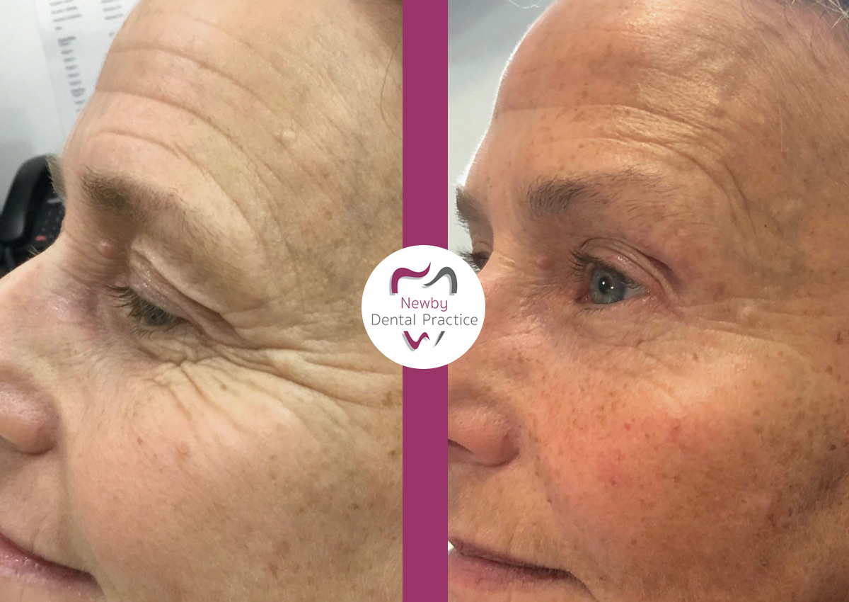 Results from a patient having Botox