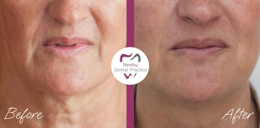 Treatment of Botox by Our dentist in Scarborough