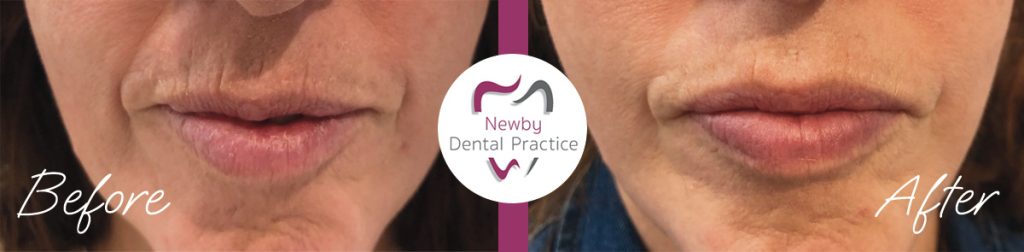 Botox before and after lip flip without dermal fillers treatment carried out in Scarborough UK