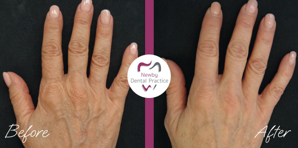 Profhilo example done at newby dental practice by a dentist 